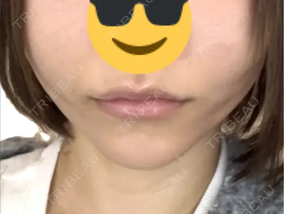 糸リフト アリエル美容クリニック 郡山院 DAY 1 メイン用