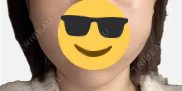 糸リフト アリエル美容クリニック 郡山院 DAY 4 メイン用