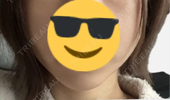 糸リフト アリエル美容クリニック 郡山院 DAY 5 メイン用