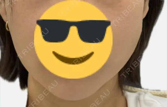 糸リフト アリエル美容クリニック 郡山院 DAY 7 メイン用