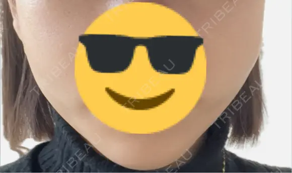 糸リフト アリエル美容クリニック 郡山院 DAY 14 メイン用