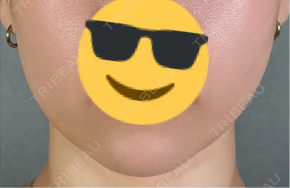 糸リフト アリエル美容クリニック 郡山院 AFTER メイン用