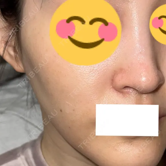 ピコスポット G MEDICAL ART クリニック 新宿院 DAY 6 メイン用