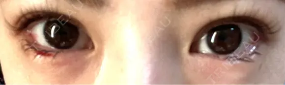 目尻切開 / タレ目形成・グラマラスライン（埋没） LOUIS CLINIC 二子玉川院【ルイクリニック】 DAY 5 メイン用