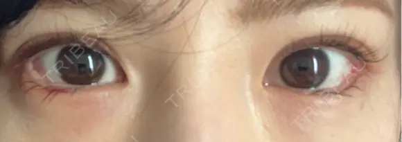 目尻切開 / タレ目形成・グラマラスライン（埋没） LOUIS CLINIC 二子玉川院【ルイクリニック】 DAY 5 メイン用