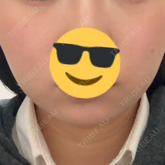 ボトックス（エラ・小顔） 共立美容外科 梅田院 DAY 14 メイン用