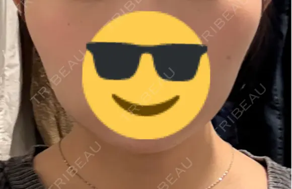 ボトックス（エラ・小顔） 共立美容外科 梅田院 AFTER メイン用