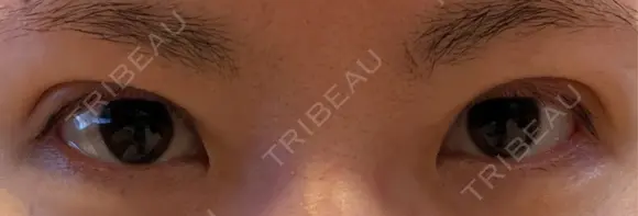 二重埋没 湘南美容クリニック 千葉センシティ院 DAY 2 メイン用