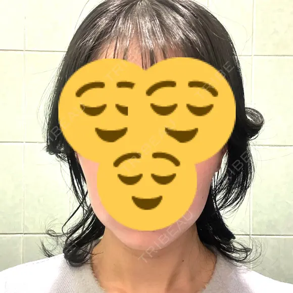 オンダリフト ルラ美容クリニック 名古屋本院 AFTER メイン用