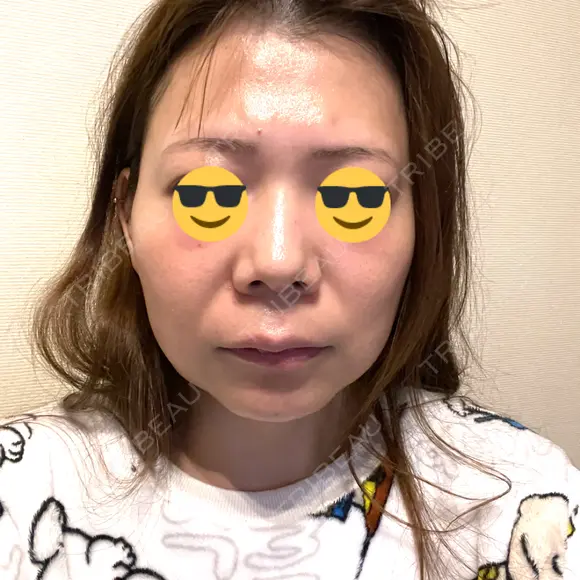 クマ治療 / 小鼻縮小（非切開） / ボトックス（あご） / ボトックス（エラ・小顔） / ボトックス（口角） TCB東京中央美容外科 新潟院 AFTER メイン用