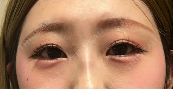 ヒアルロン酸注入（涙袋） ルラ美容クリニック 宇都宮院 AFTER メイン用