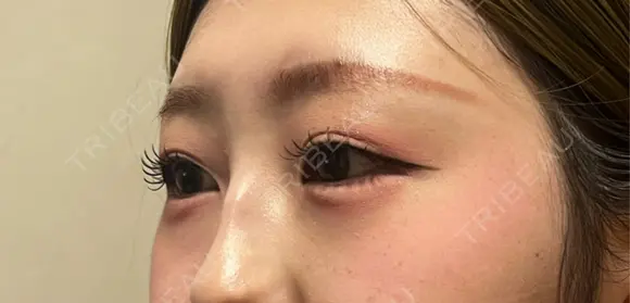 ヒアルロン酸注入（涙袋） ルラ美容クリニック 宇都宮院 DAY 1 メイン用