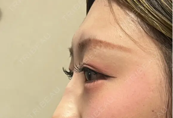 ヒアルロン酸注入（涙袋） ルラ美容クリニック 宇都宮院 DAY 1 メイン用