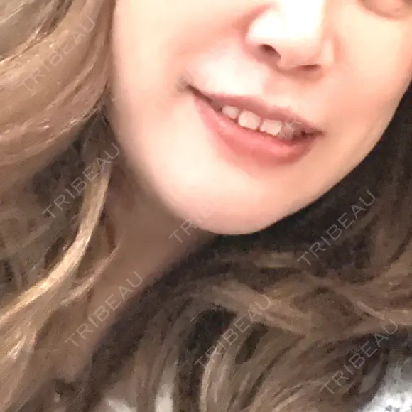 ピコレーザートーニング（美白・肝斑） / ピコフラクショナルレーザー（毛穴・ニキビ跡） / ピコスポット 東京シルククリニック 新宿院 AFTER メイン用