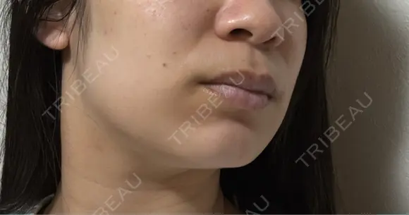 イオン導入 / 毛穴洗浄（ハイドラフェイシャルなど） ルラ美容クリニック 宇都宮院 DAY 0 メイン用