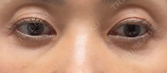 スネコス 札幌美容外科ネビュラクリニック AFTER メイン用