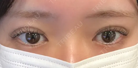 二重埋没 EMMA CLINIC（エマクリニック） DAY 4 メイン用