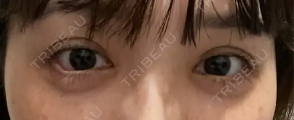 目尻切開 / タレ目形成・グラマラスライン（埋没） LOUIS CLINIC 二子玉川院【ルイクリニック】 DAY 6 メイン用