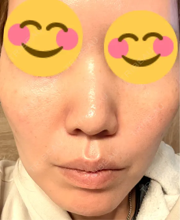 肌育注射（ジュベルックなど） 城本クリニック 豊橋院 AFTER メイン用