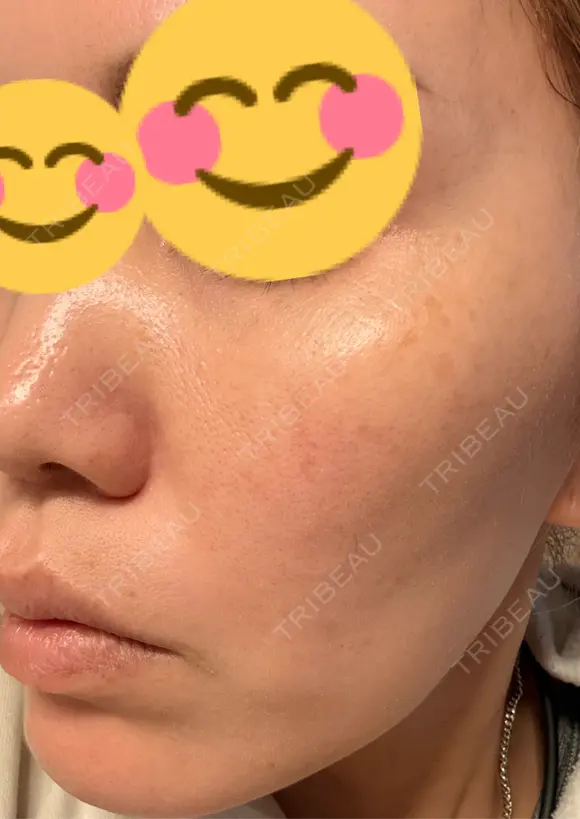 肌育注射（ジュベルックなど） 城本クリニック 豊橋院 DAY 12 メイン用