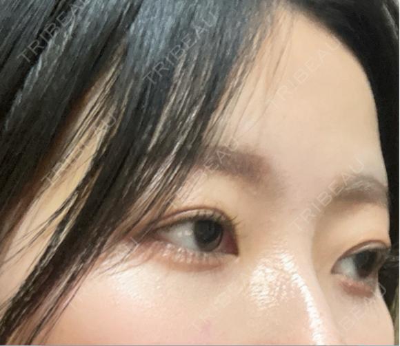 二重埋没 / その他（目元） LUHO（ルホ）美容外科 AFTER メイン用