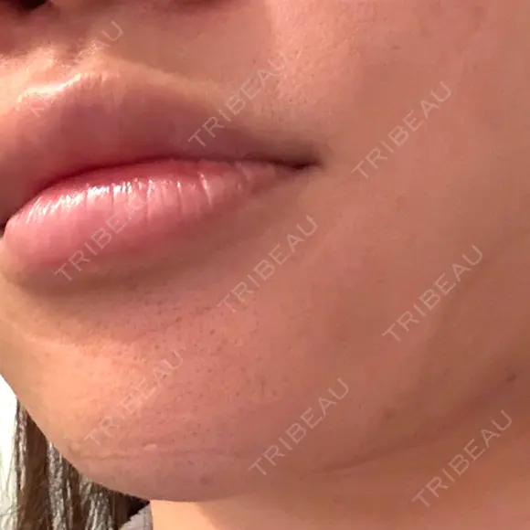 脂肪吸引（顔） プライベートスキンクリニック 梅田本院 DAY 0 メイン用