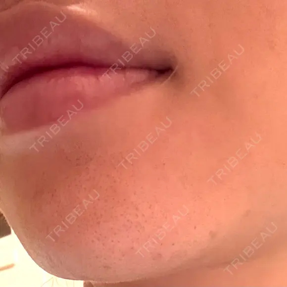 脂肪吸引（顔） プライベートスキンクリニック 梅田本院 AFTER メイン用