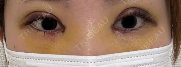 二重埋没 / 目頭切開 湘南美容クリニック 千葉センシティ院 DAY 6 メイン用