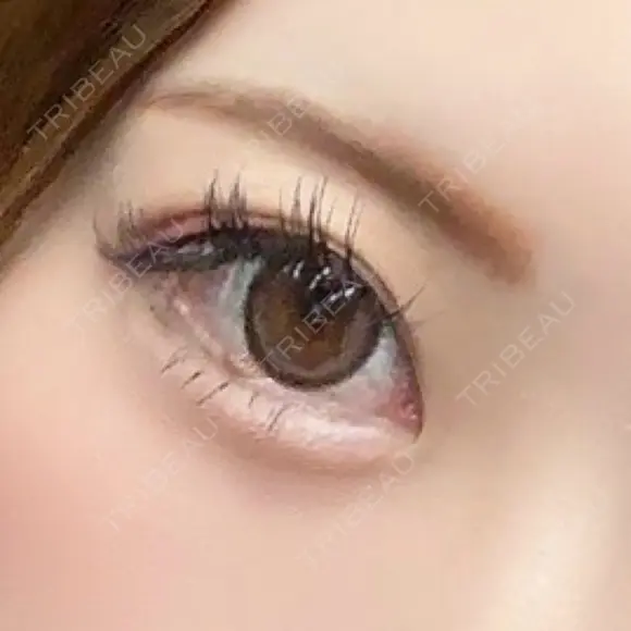 ヒアルロン酸注入（涙袋） ルラ美容クリニック 横浜院 AFTER メイン用