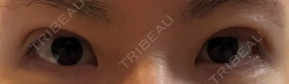 二重埋没 湘南美容クリニック 千葉センシティ院 DAY 3 メイン用