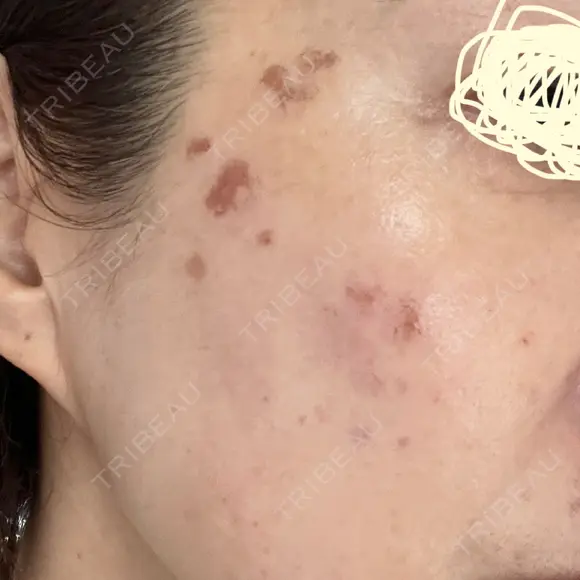 プラセンタ注射 / シミ取りレーザー S-Laboクリニック 渋谷院 DAY 3 メイン用