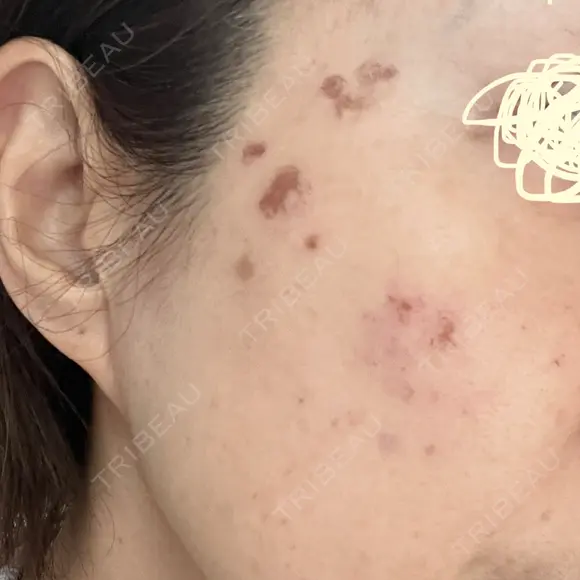 プラセンタ注射 / シミ取りレーザー S-Laboクリニック 渋谷院 DAY 4 メイン用