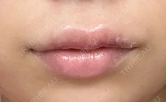 口唇縮小術 博多美容外科/美容皮膚科 ビラビューティークリニック DAY 14 メイン用