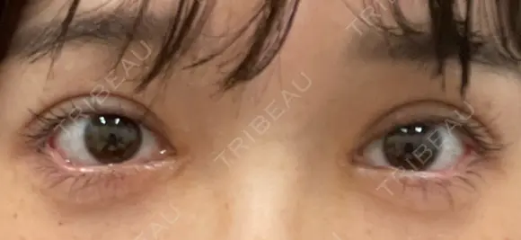 目尻切開 / タレ目形成・グラマラスライン（埋没） LOUIS CLINIC 二子玉川院【ルイクリニック】 AFTER メイン用