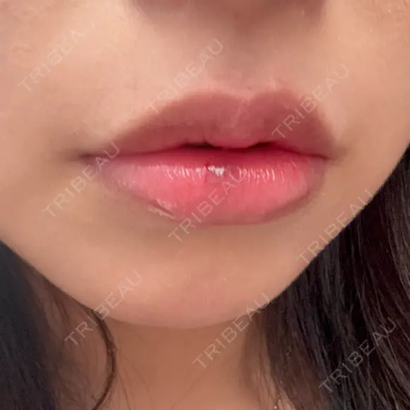 その他（口元） ルラ美容クリニック 大阪心斎橋院 DAY 0 メイン用