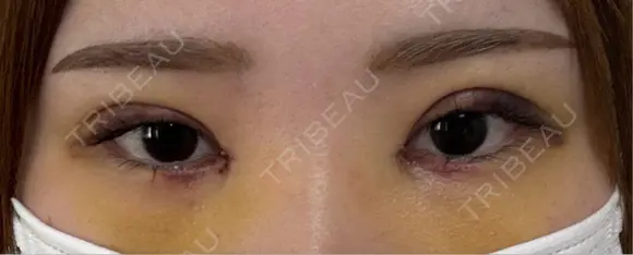 二重埋没 / 目頭切開 湘南美容クリニック 千葉センシティ院 DAY 7 メイン用