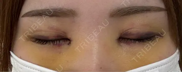 二重埋没 / 目頭切開 湘南美容クリニック 千葉センシティ院 DAY 7 メイン用