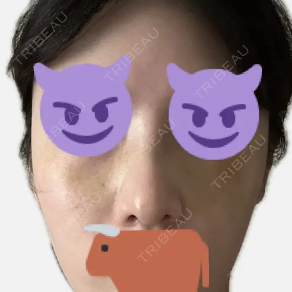 隆鼻術 / 鼻尖形成（切開） / 軟骨移植 / 鼻中隔延長（非切開） X CLINIC 大阪院 DAY 13 メイン用