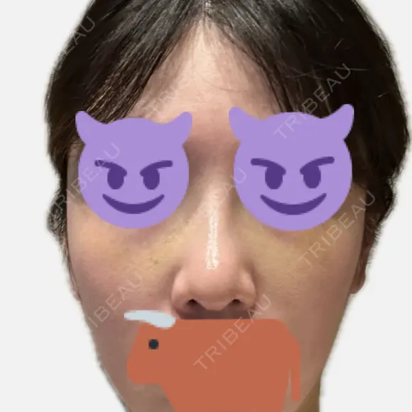 隆鼻術 / 鼻尖形成（切開） / 軟骨移植 / 鼻中隔延長（非切開） X CLINIC 大阪院 DAY 14 メイン用