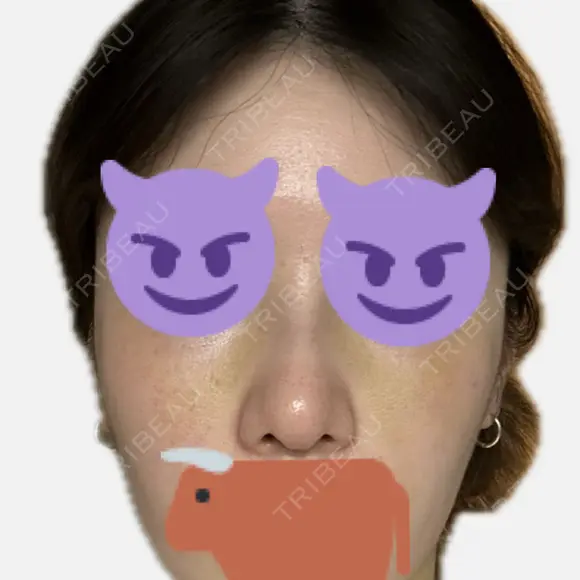 隆鼻術 / 鼻尖形成（切開） / 軟骨移植 / 鼻中隔延長（非切開） X CLINIC 大阪院 DAY 16 メイン用