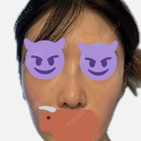 隆鼻術 / 鼻尖形成（切開） / 軟骨移植 / 鼻中隔延長（非切開） X CLINIC 大阪院 DAY 26 メイン用