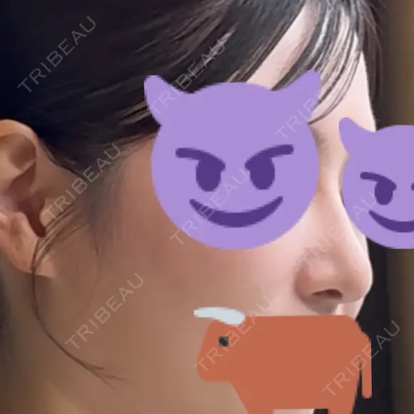 隆鼻術 / 鼻尖形成（切開） / 軟骨移植 / 鼻中隔延長（非切開） X CLINIC 大阪院 AFTER メイン用