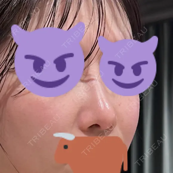 隆鼻術 / 鼻尖形成（切開） / 軟骨移植 / 鼻中隔延長（非切開） X CLINIC 大阪院 DAY 166 メイン用