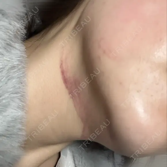 ボトックス（エラ・小顔） / RF（高周波）たるみ治療 大美会クリニック 梅田院 DAY 0 メイン用