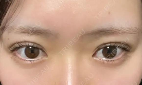 二重埋没 EMMA CLINIC（エマクリニック） DAY 5 メイン用