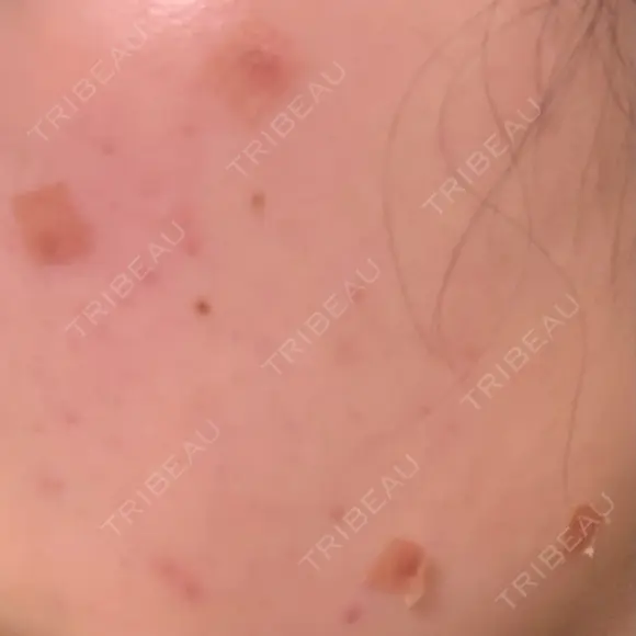 ほくろ・いぼ除去レーザー（肌） 心斎橋KT美容クリニック DAY 8 メイン用