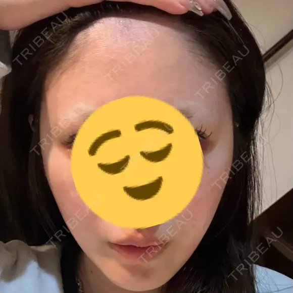 糸リフト A CLINIC（エークリニック） 大阪院 DAY 19 メイン用