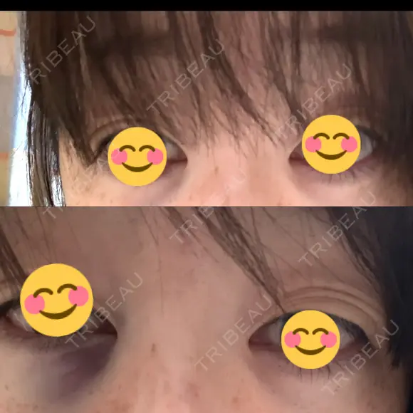 クマ治療 / 下まぶたたるみ取り / 下まぶたの脂肪取り 千葉美容外科アイビークリニック DAY 0 メイン用