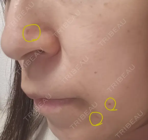 ほくろ・いぼ切除（肌） CLINIC W DAY 16 メイン用