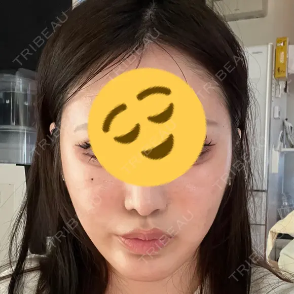 その他（口元） A CLINIC（エークリニック） 大阪院 DAY 20 メイン用
